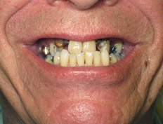 Upper Dentures